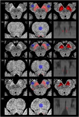 Neuromelanin magnetic resonance imaging of substantia nigra and locus coeruleus in Parkinson’s disease with freezing of gait